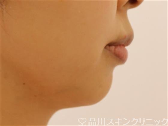 症例NO.40932のBEFORE写真