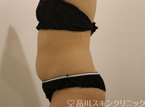 症例NO.42357のBEFORE写真