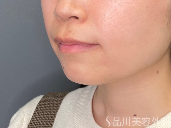 症例NO.65462のBEFORE写真