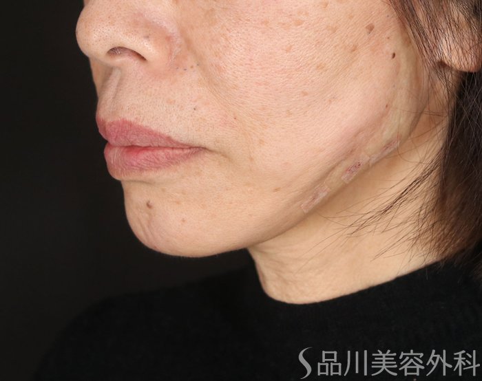 症例NO.72897のAFTER写真