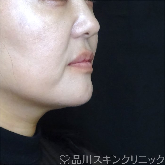 症例NO.70950のBEFORE写真