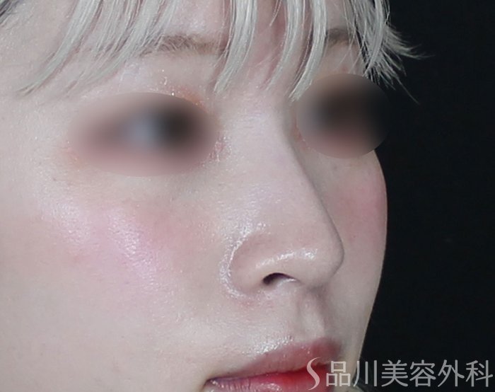 症例NO.69657のBEFORE写真