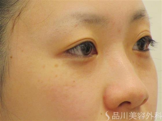 症例NO.55379のBEFORE写真