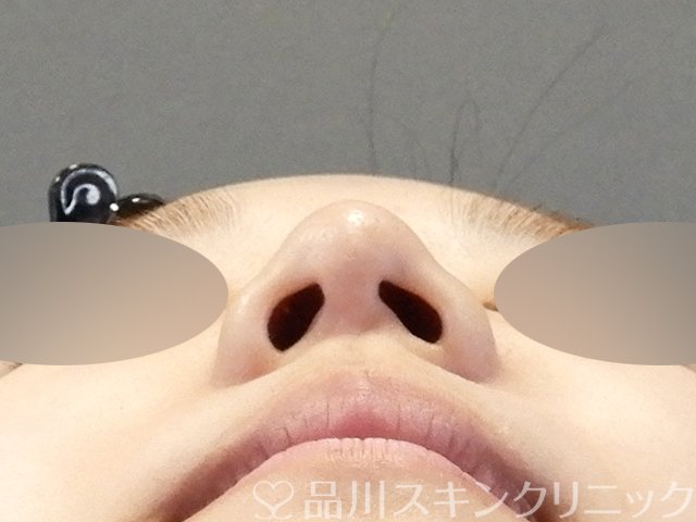 症例NO.66078のBEFORE写真
