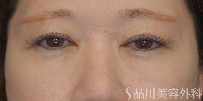 症例NO.73036のAFTER写真