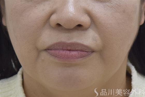 症例NO.47630のBEFORE写真