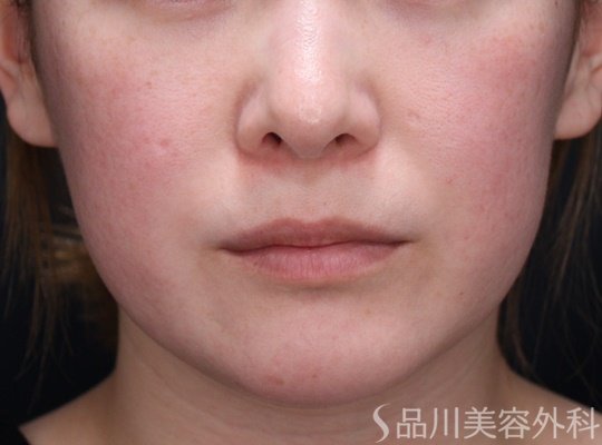 症例NO.65446のBEFORE写真