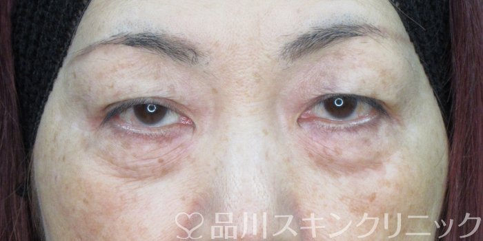 症例NO.73547のBEFORE写真