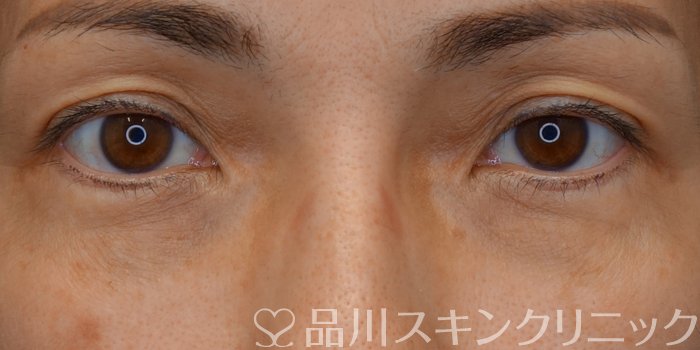 症例NO.71007のBEFORE写真