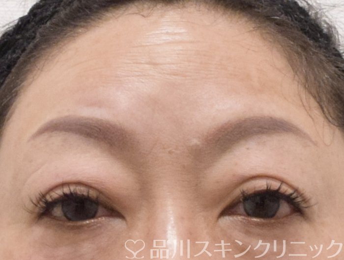 症例NO.75255のAFTER写真