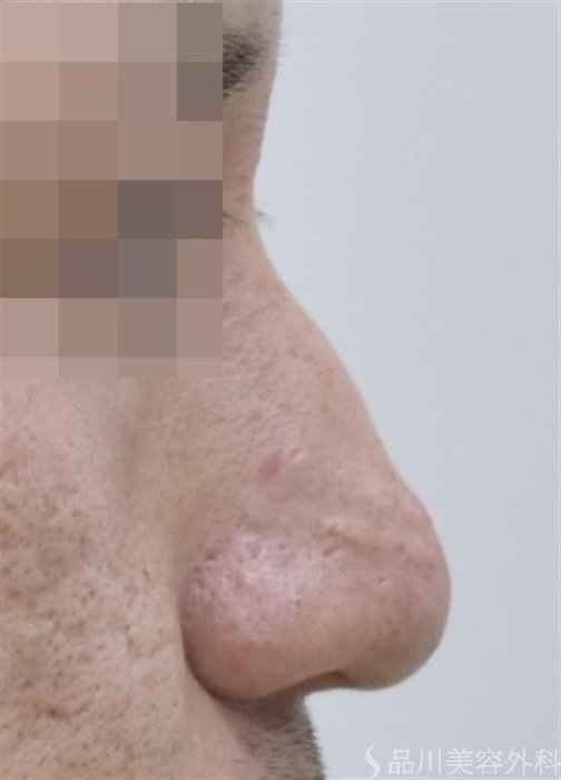 症例NO.48136のBEFORE写真