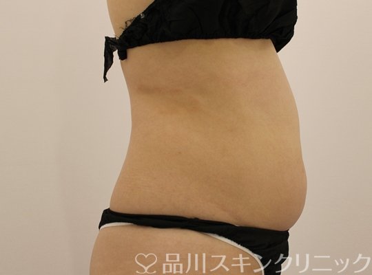 症例NO.74086のBEFORE写真