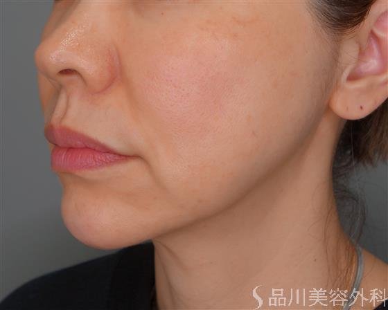 症例NO.53472のBEFORE写真