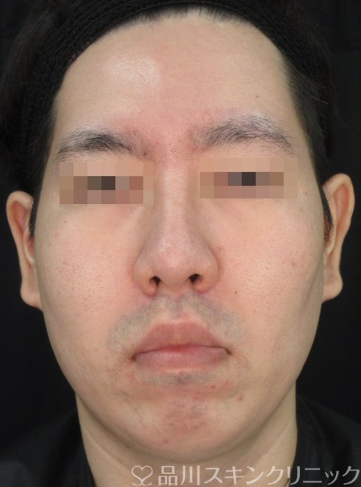 症例NO.72307のAFTER写真