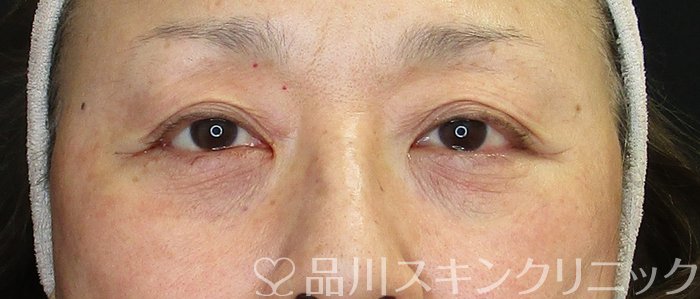 症例NO.75099のAFTER写真