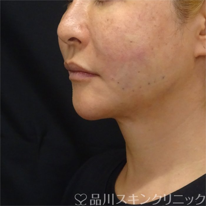 症例NO.72387のAFTER写真