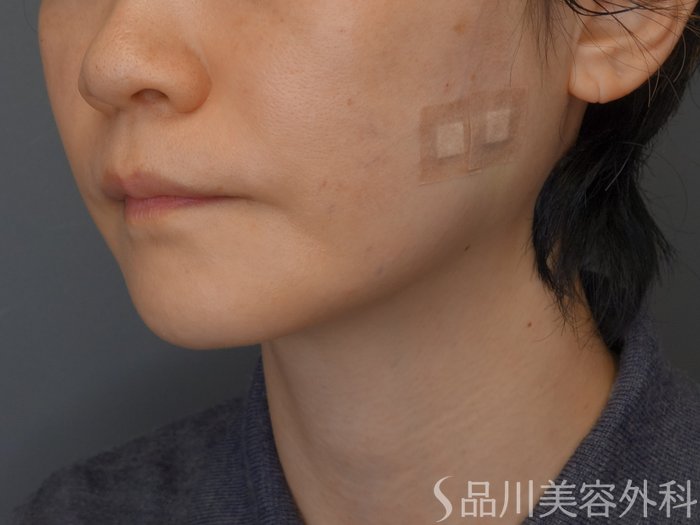 症例NO.72440のAFTER写真