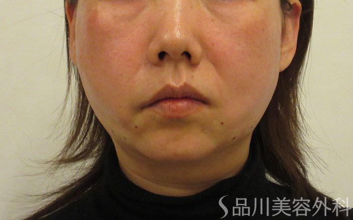 症例NO.73220のAFTER写真