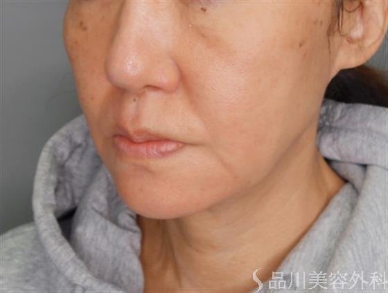 症例NO.55033のBEFORE写真