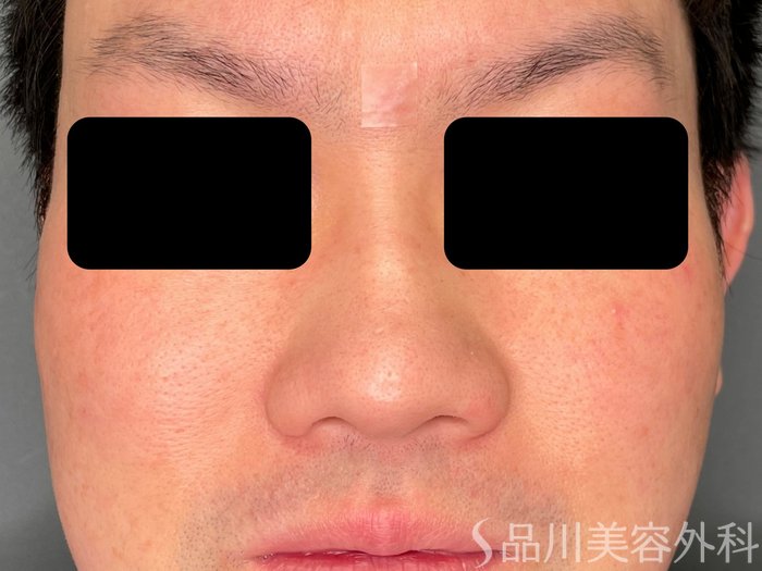 症例NO.74469のBEFORE写真