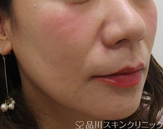症例NO.45330のBEFORE写真