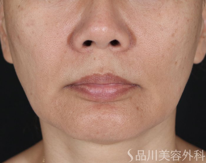 症例NO.71386のBEFORE写真
