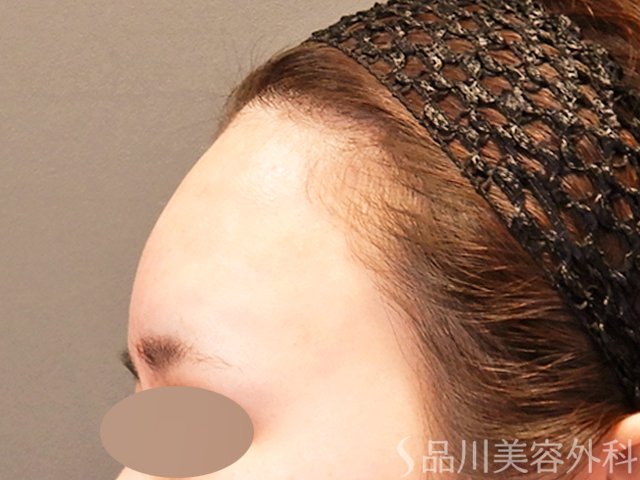 症例NO.69953のAFTER写真