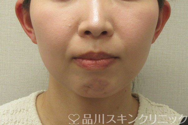 症例NO.74576のBEFORE写真