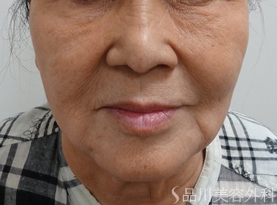 症例NO.72566のBEFORE写真