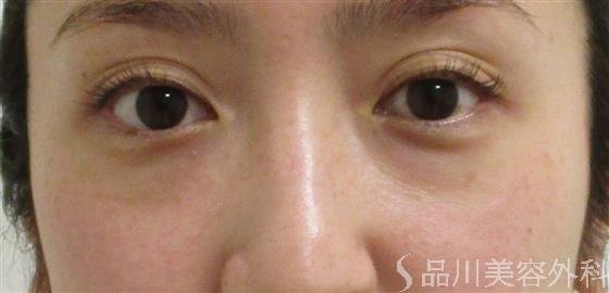症例NO.55223のBEFORE写真