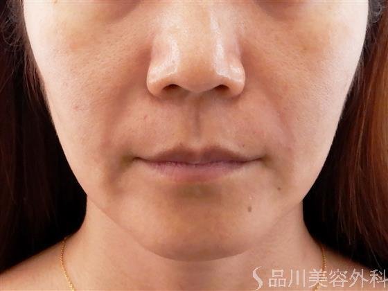 症例NO.61912のAFTER写真