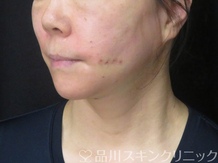 症例NO.69371のAFTER写真