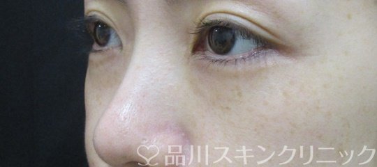 症例NO.74796のBEFORE写真