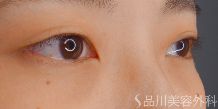 症例NO.72352のBEFORE写真