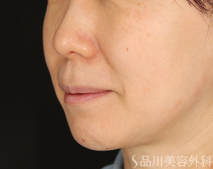 症例NO.74166のBEFORE写真