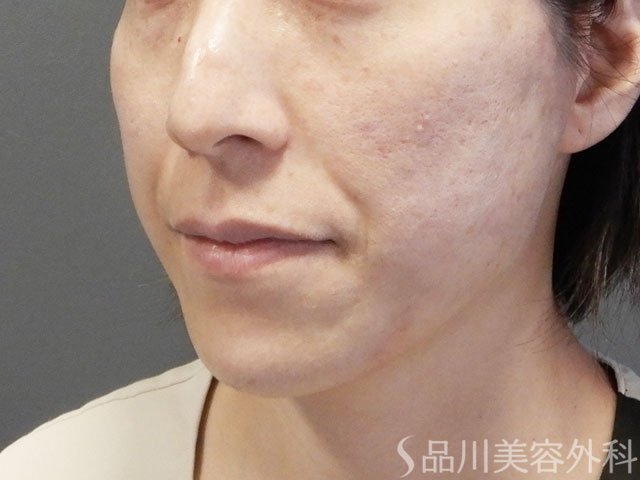 症例NO.72164のAFTER写真