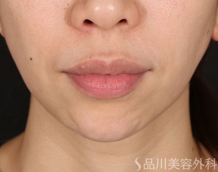症例NO.71129のBEFORE写真