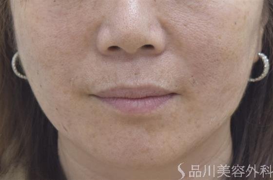 症例NO.46121のAFTER写真
