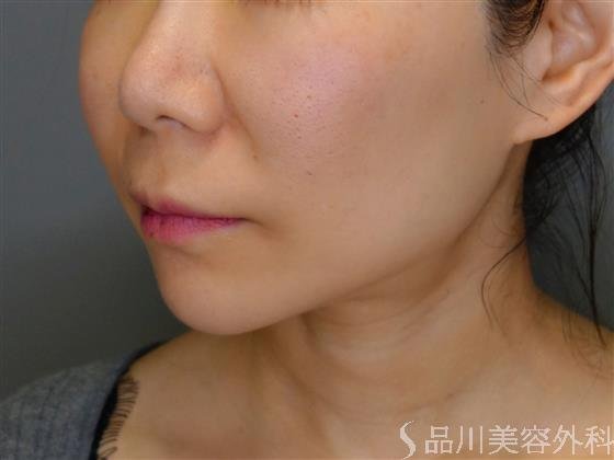 症例NO.50861のBEFORE写真