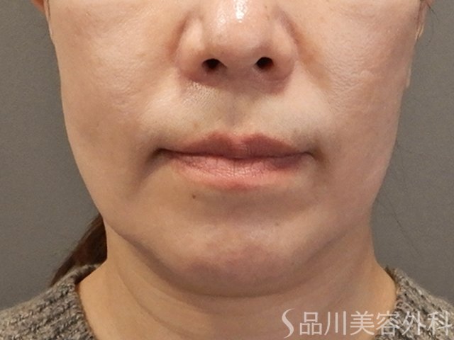 症例NO.73268のAFTER写真