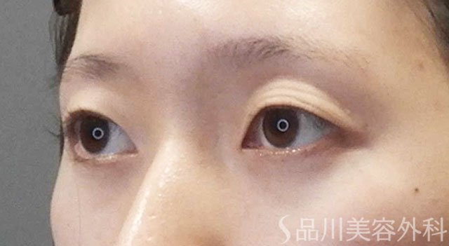 症例NO.65471のBEFORE写真
