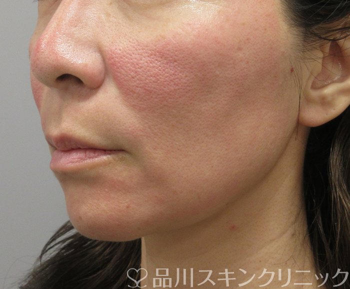 症例NO.74197のBEFORE写真