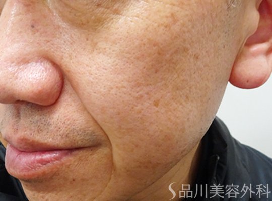 症例NO.70889のAFTER写真