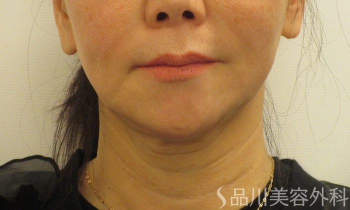 症例NO.73083のBEFORE写真