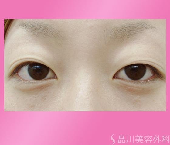 症例NO.862のBEFORE写真