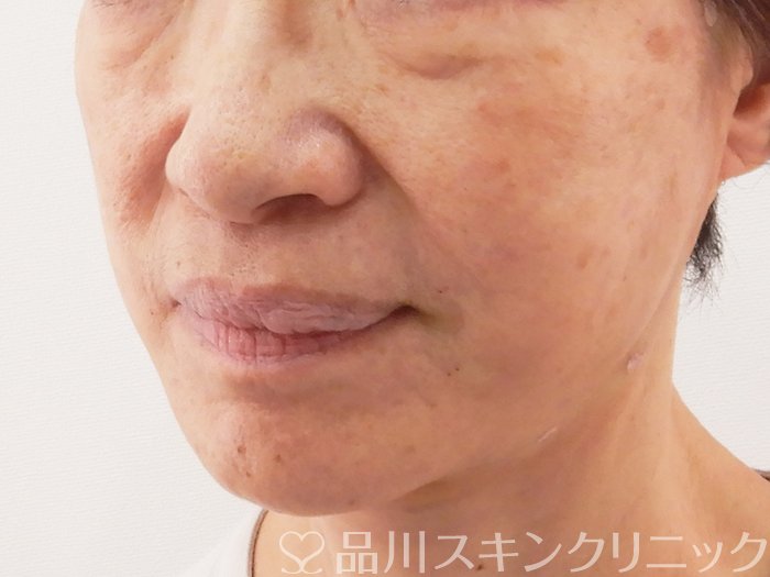症例NO.62649のAFTER写真