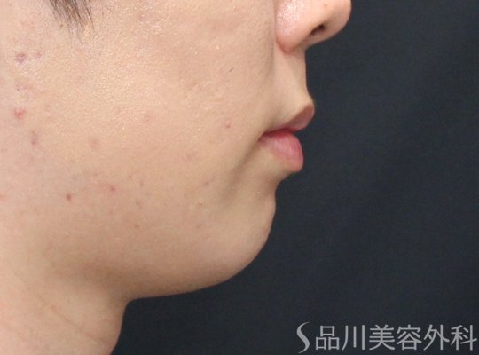 症例NO.75181のBEFORE写真