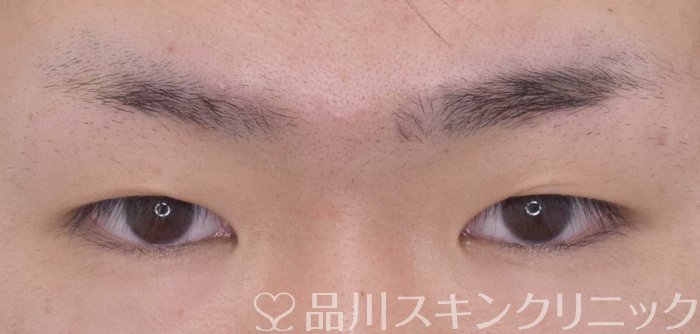 症例NO.62894のBEFORE写真