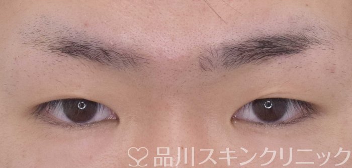 症例NO.62894のBEFORE写真