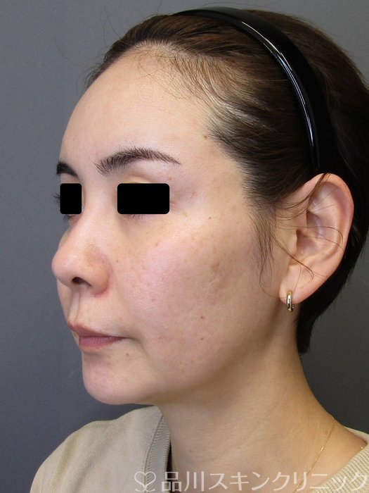 症例NO.75184のBEFORE写真